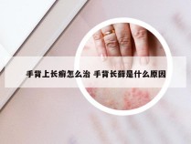 手背上长癣怎么治 手背长藓是什么原因