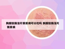 胸腺肽肠溶片银屑病可以吃吗 胸腺肽肠溶片 银屑病