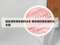 糖尿病和银屑病的关系 糖尿病和银屑病的关系图