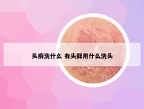 头癣洗什么 有头藓用什么洗头