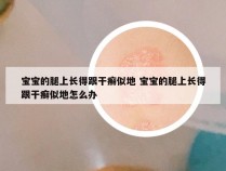 宝宝的腿上长得跟干癣似地 宝宝的腿上长得跟干癣似地怎么办