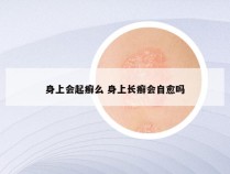 身上会起癣么 身上长癣会自愈吗