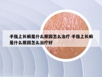 手指上长癣是什么原因怎么治疗 手指上长癣是什么原因怎么治疗好