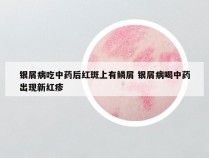 银屑病吃中药后红斑上有鳞屑 银屑病喝中药出现新红疹