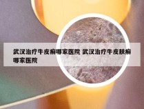 武汉治疗牛皮癣哪家医院 武汉治疗牛皮肤癣哪家医院