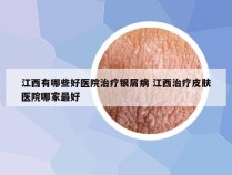 江西有哪些好医院治疗银屑病 江西治疗皮肤医院哪家最好