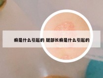 癣是什么引起的 腿部长癣是什么引起的