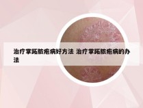 治疗掌跖脓疱病好方法 治疗掌跖脓疱病的办法