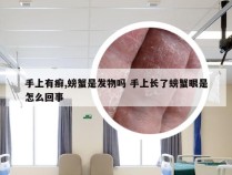 手上有癣,螃蟹是发物吗 手上长了螃蟹眼是怎么回事