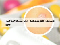 治疗头皮癣的小秘方 治疗头皮癣的小秘方有哪些