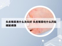 头皮银屑用什么洗头好 头皮银屑吃什么药能缓解病情