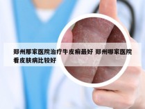 郑州那家医院治疗牛皮癣最好 郑州哪家医院看皮肤病比较好