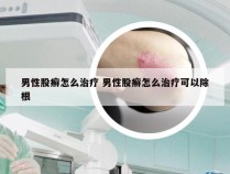 男性股癣怎么治疗 男性股癣怎么治疗可以除根