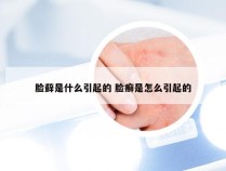 脸藓是什么引起的 脸癣是怎么引起的