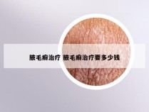 腋毛癣治疗 腋毛癣治疗要多少钱