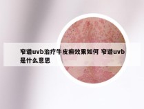 窄谱uvb治疗牛皮癣效果如何 窄谱uvb是什么意思