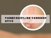 牛皮癣图片来迎泽中心银屑 牛皮银屑癣有效治疗方法