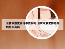 没有家族史会得牛皮癣吗 没有家族史得癌症的概率高吗