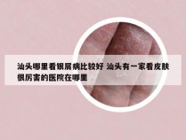 汕头哪里看银屑病比较好 汕头有一家看皮肤很厉害的医院在哪里