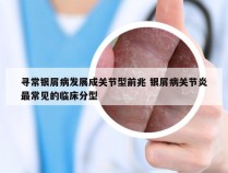 寻常银屑病发展成关节型前兆 银屑病关节炎最常见的临床分型