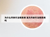 为什么丹参片治银屑病 复方丹参片治银屑病吗