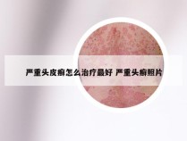 严重头皮癣怎么治疗最好 严重头癣照片