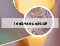 牜皮癣是什么症状 皮癣的症状