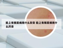 脸上有银屑病用什么软膏 脸上有银屑病用什么药膏