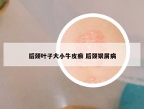 后颈叶子大小牛皮癣 后颈银屑病