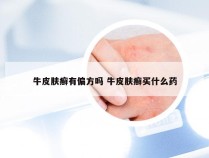 牛皮肤癣有偏方吗 牛皮肤癣买什么药