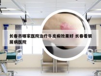 长春市哪家医院治疗牛皮癣效果好 长春看银屑病医院