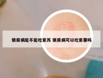 银屑病能不能吃紫苏 银屑病可以吃紫薯吗