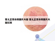 婴儿正常白斑图片大腿 婴儿正常白斑图片大腿红斑