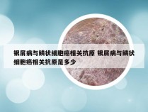 银屑病与鳞状细胞癌相关抗原 银屑病与鳞状细胞癌相关抗原是多少