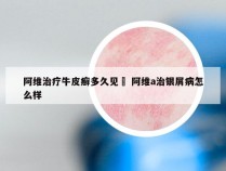 阿维治疗牛皮癣多久见効 阿维a治银屑病怎么样