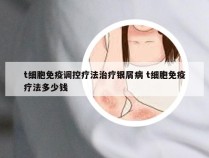 t细胞免疫调控疗法治疗银屑病 t细胞免疫疗法多少钱