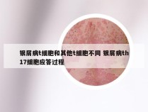 银屑病t细胞和其他t细胞不同 银屑病th17细胞应答过程