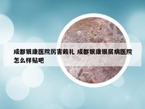 成都银康医院厉害戴礼 成都银康银屑病医院怎么样贴吧