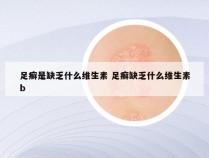 足癣是缺乏什么维生素 足癣缺乏什么维生素b