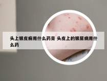 头上银皮癣用什么药膏 头皮上的银屑病用什么药