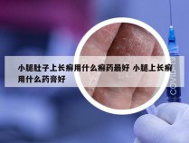 小腿肚子上长癣用什么癣药最好 小腿上长癣用什么药膏好