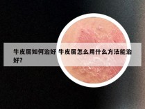 牛皮屑如何治好 牛皮屑怎么用什么方法能治好?