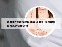 维生素C怎样治好银屑病 维生素c治疗银屑病多长时间能见效