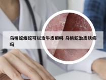 乌梢蛇蝮蛇可以治牛皮癣吗 乌梢蛇治皮肤病吗