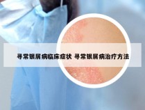 寻常银屑病临床症状 寻常银屑病治疗方法