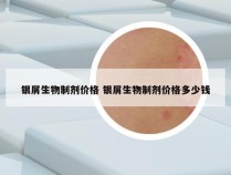 银屑生物制剂价格 银屑生物制剂价格多少钱