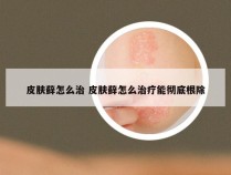 皮肤藓怎么治 皮肤藓怎么治疗能彻底根除