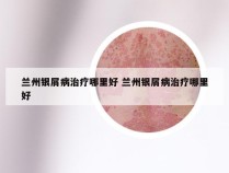 兰州银屑病治疗哪里好 兰州银屑病治疗哪里好