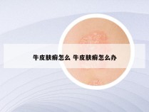 牛皮肤癣怎么 牛皮肤癣怎么办