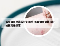 长春银屑病比较好的医院 长春银屑病比较好的医院是哪家